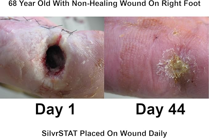 SilvrSTAT First Aid Kit Gel | 32 PPM Silver Healing Wound Dressing Gel | SilverSol Ag₄O₄ Particles | 1 oz